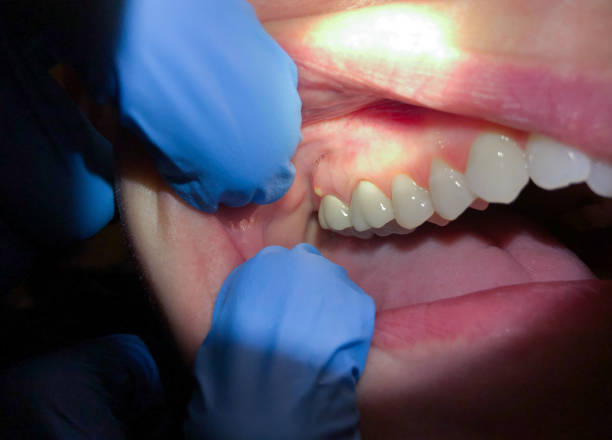 Best Emergency Gum Treatment in Baldwinville, MA