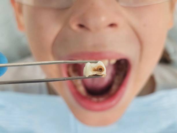 Best Emergency Treatment for Dental Infections or Abscesses in Baldwinville, MA
